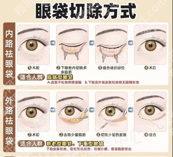 内路祛眼袋和外路祛眼袋的区别：2张表分清差异！3个真实案例教你选对不踩雷