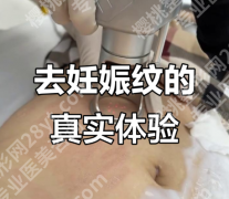 妊娠纹能修复吗？哪家医院正规？3个案例+数据给答案