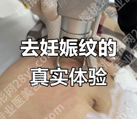 妊娠纹能修复吗？哪家医院正规？3个案例+数据给答案
