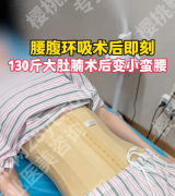腰腹环吸的疤痕在哪里？2025实测指南+4类案例+避坑攻略
