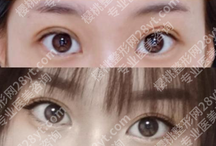 哈尔滨瑞丽做双眼皮多少钱？2025价目表+3类眼型适配方案