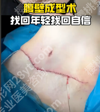 成都腹壁整形术好的医院：2025实测榜单+案例+避坑指南