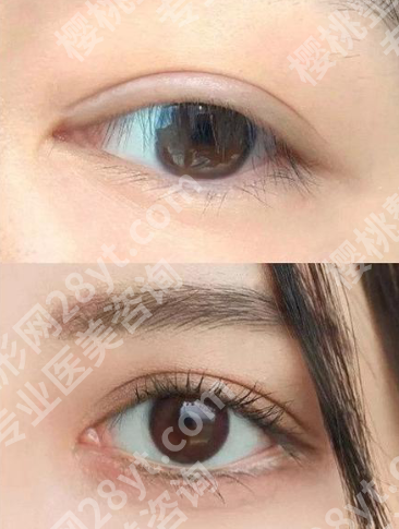 西安何林做的双眼皮怎么样？交大一附院名医+真实案例+价格，闭眼冲不踩坑