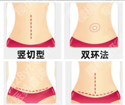 长沙腹壁整形术好的医生是谁？5位公立三甲名医+真实案例，产后妈妈必藏