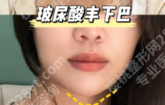 自体脂肪丰下巴能保持多长时间？真实案例+数据拆解，答案藏在这3个细节里