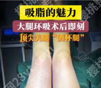 大腿吸脂和腹部吸脂哪个更疼？真实体验+数据拆解，怕疼星人必看