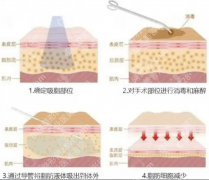 负压吸脂的操作过程拆解：从术前准备到术后恢复，干货满满不踩坑