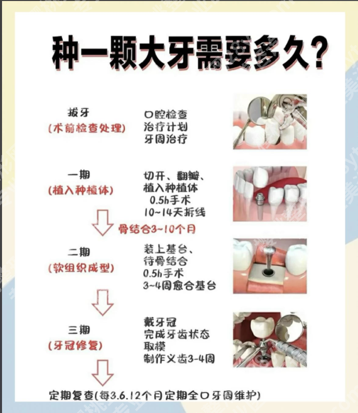 上海六院种植牙大概多少钱一颗啊？来看4个核心影响因素