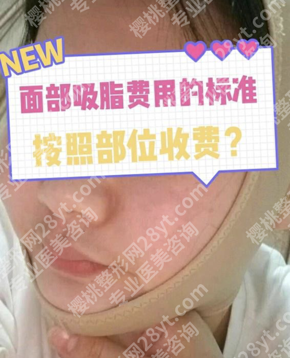深圳面部吸脂的价格多少？一张表看清所有花费明细