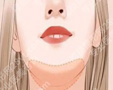 膨体垫下巴恢复期多久？恢复时间+注意事项了解