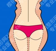 腰腹环吸的脂肪可以填屁股吗？过来人实测般的干货科普