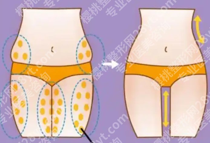 大腿吸脂哪个医院做得好？公立VS私立真实测评，想做“筷子腿”的姐妹别乱冲