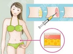 负压吸脂的优缺点，效果维持时间、风险点与适合人群一次说清
