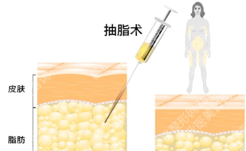 杭州吸脂好的三甲医院排名，技术实力+热门医生榜单一次看够