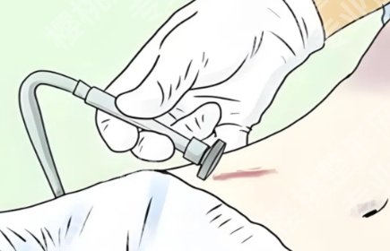 上海华山医院去疤痕多少钱？在华山医院价格差多少？真实费用参考