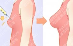 脂肪丰胸和假体丰胸的区别，手感、风险、维持时间全面对比
