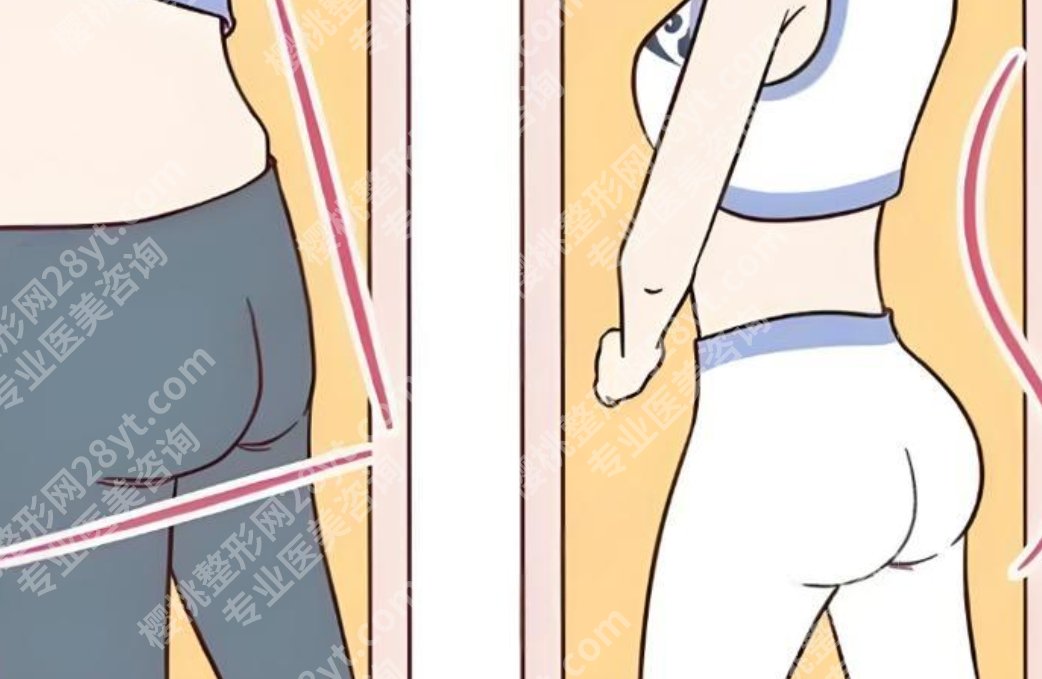 臀假体多少钱？术费用构成拆解：假体、麻醉、住院逐项算清