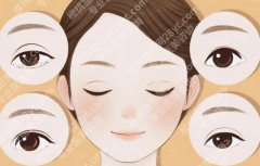 开外眼角会回缩吗？外眼角术后变化时间线：术后1个月、3个月、半年形态变化说明