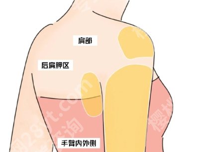 肩膀吸脂手术多少钱？手术费用构成：麻醉费、耗材费、塑身衣费用拆解