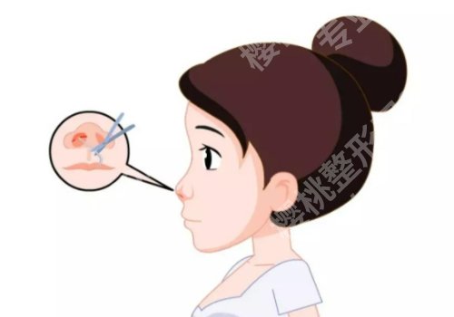 上海九院做假体隆鼻要多少钱？1.8w元起，2026新价格表、核心项目公布
