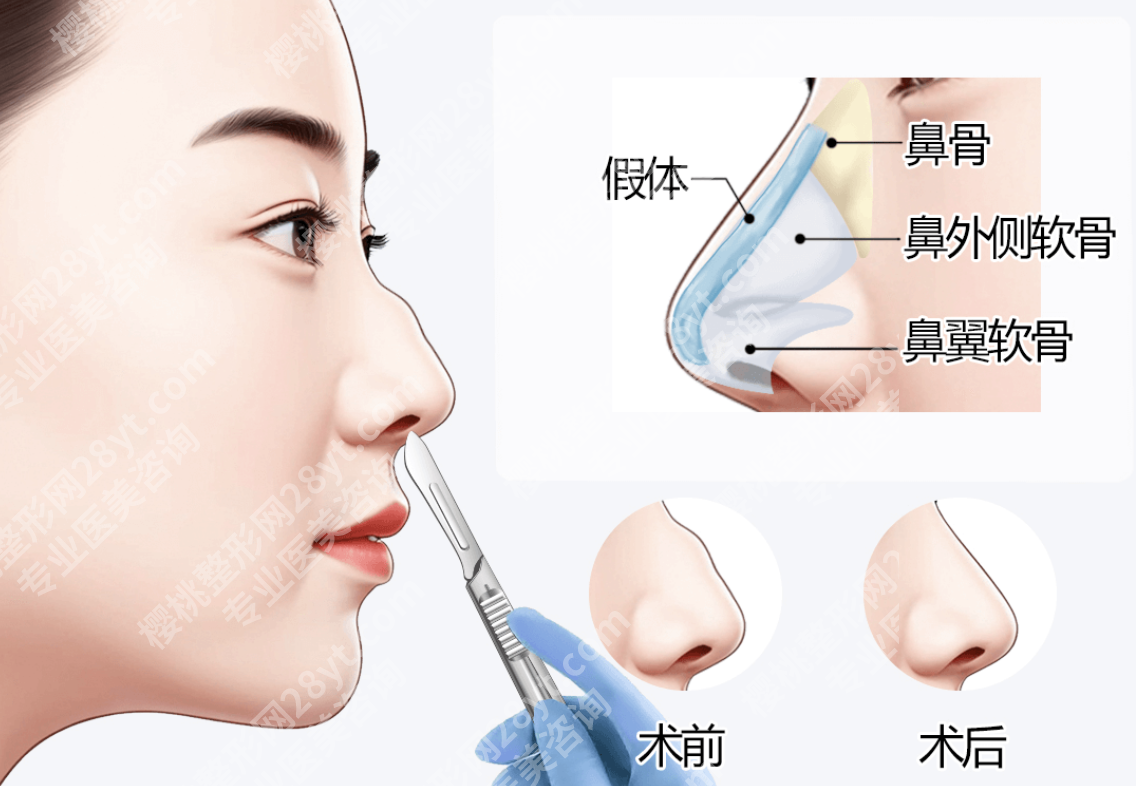南方医院取假体鼻子多少钱啊？2026新价目+真实案例，看完不踩坑