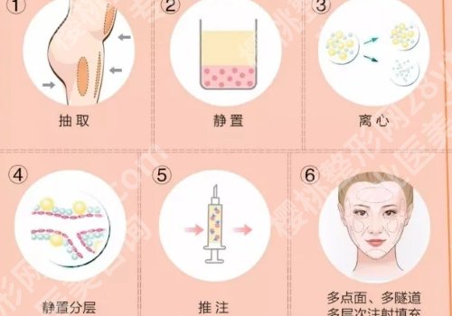 八大处脂肪填充额头得多少钱？6k元起，主打项目+常见问题展示！