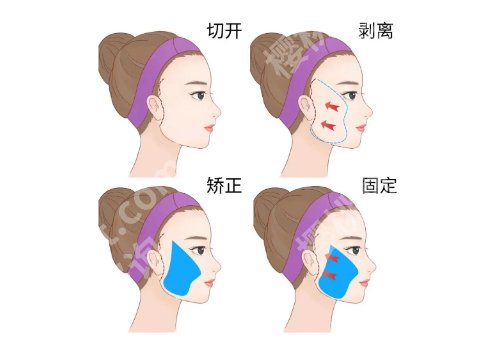 上海第九人民医院拉皮手术哪位医生做的好？速看靠谱医生详情分享！