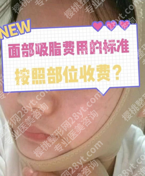 山东省立医院面部吸脂价格出炉,3个核心变量决定你要花多少钱