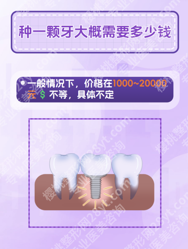 浙一种植牙多少钱一颗？集采落地，告别“雾里看花”