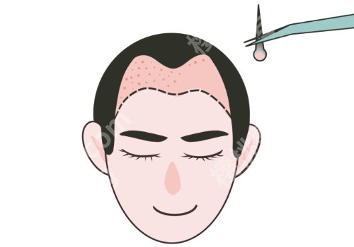 西安西京医院头发种植怎么样？西北地区扛把子、附口碑点评、真实案例