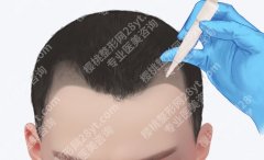 八大处植发多少钱一个单位，收费标准、单位数量估算和整体预算示例