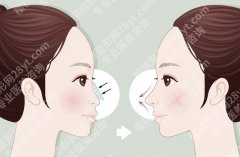 西京医院隆鼻价目表，几种常见项目、加项费用和整体预算一文搞清