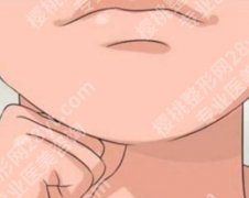 垫下巴后注意事项有哪些？术后护理避雷，消肿快一倍