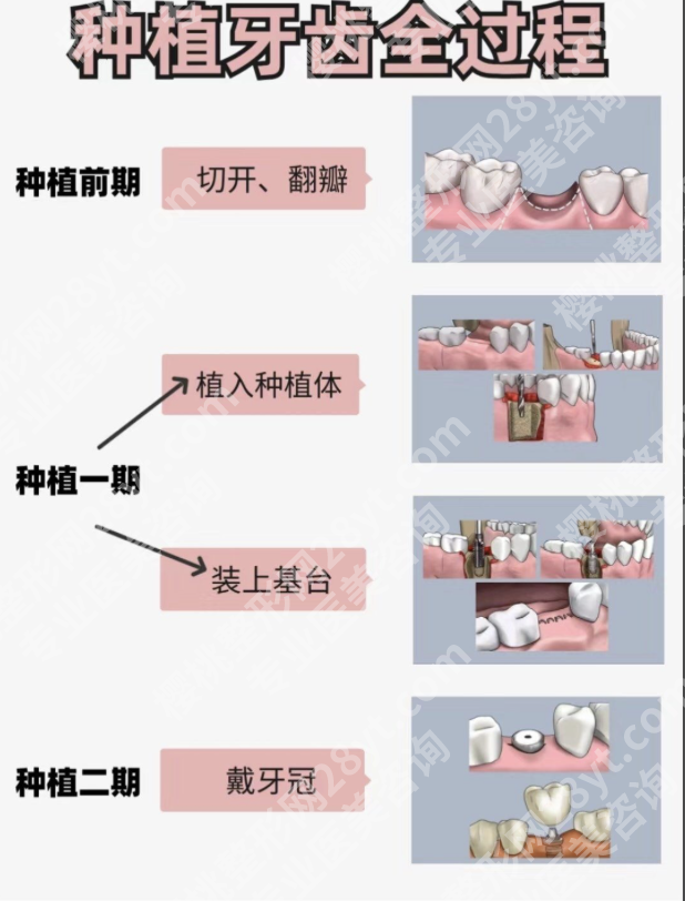 南方医院种植牙技术怎样？缺牙党别再踩坑