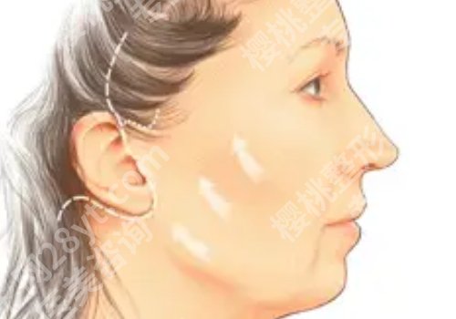 上海九院拉皮怎么样？抗衰王牌、放心体验不踩雷！网友点评、案例曝光