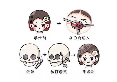 上海九院下颌角手术多少钱？2万元起，费用明细+医生+面诊技巧！