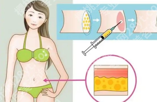 上海九院抽脂挂什么科？正确科室、挂号入口和注意事项整理