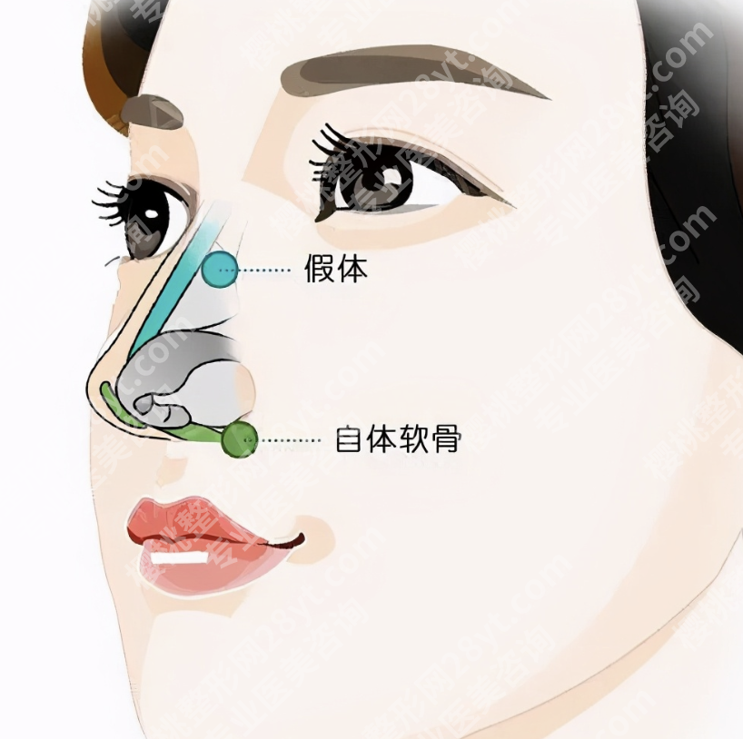 浙二医院隆鼻哪个医生好？案例+技术+面诊体验全拆解