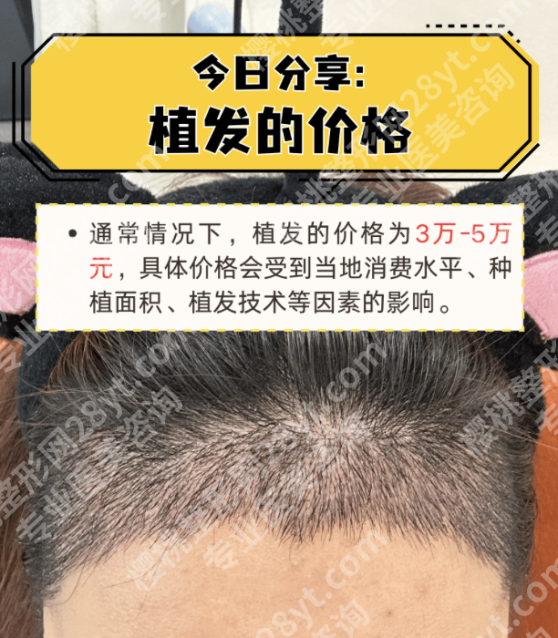 四川华西医院植发价格表：不同技术差在哪？钱该怎么花？