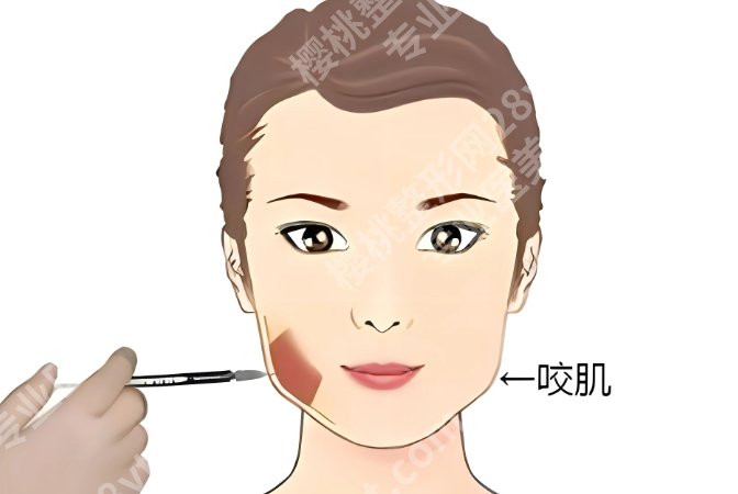 浙二医院瘦脸怎么样？瘦脸针、面部吸脂等常见方式体验与反馈总结
