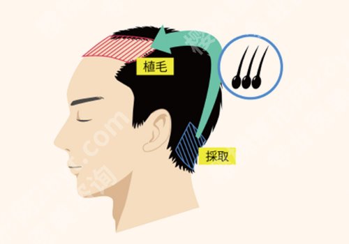 上海九院植发哪个医生好？刘清、吴巍等医生纷纷上榜！