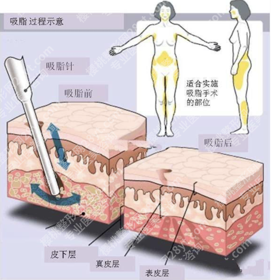 山东省立医院吸脂手术怎么样？从术前到术后的全周期管控