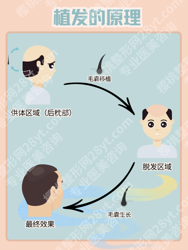 山东省立医院植发吗？流程是怎样的呢？