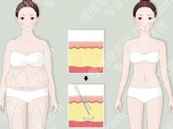 浙医二院抽脂怎么样？常做部位、效果反馈和术后恢复真实解析