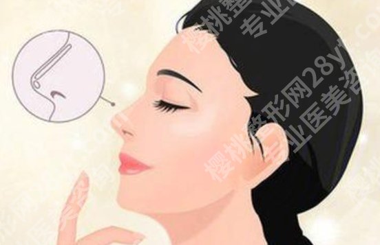 北京301医院隆鼻价格，假体、自体软骨、综合鼻整形价格区间解析