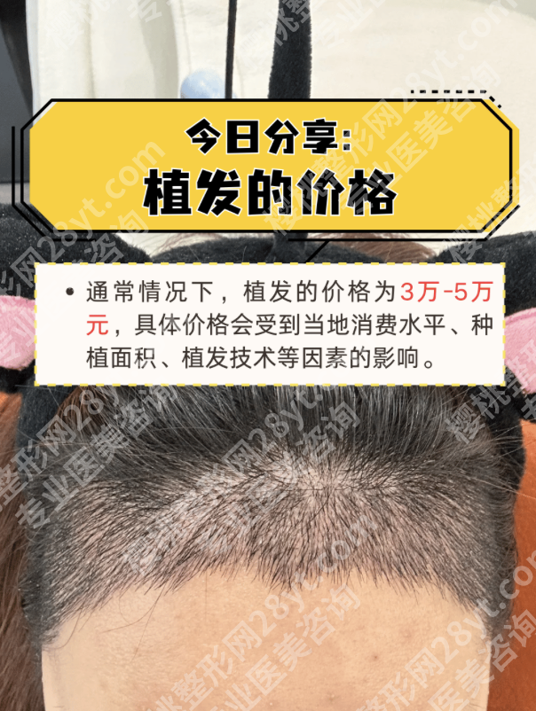 上海第二人民医院植发价格大揭秘！2026新版藏不住了