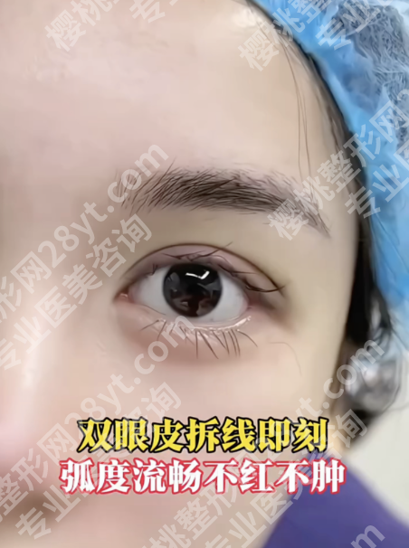 南方医院割双眼皮怎么样?真实反馈+性价比全拆解
