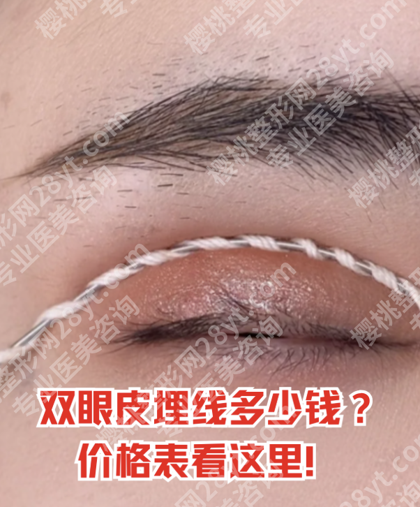 华西医院双眼皮埋线多少钱？从线材选择看价格分层
