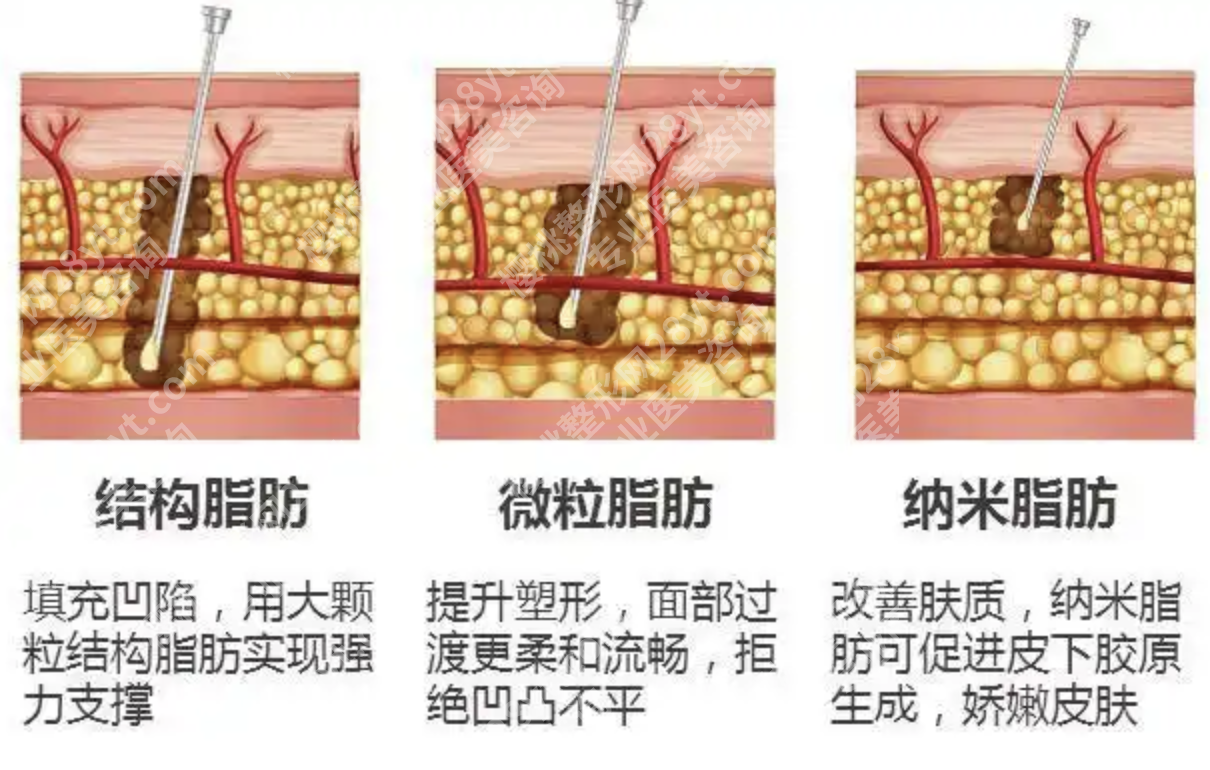 华西脂肪填充怎么样啊？这篇实测帮你避掉99%的雷