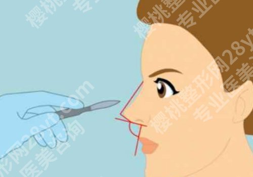 八大处隆鼻多少钱？怎么样？1万元起，从价格明细到医生全方位揭秘